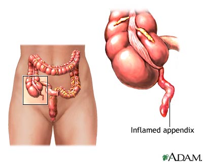 Appendicitis Appendicitis