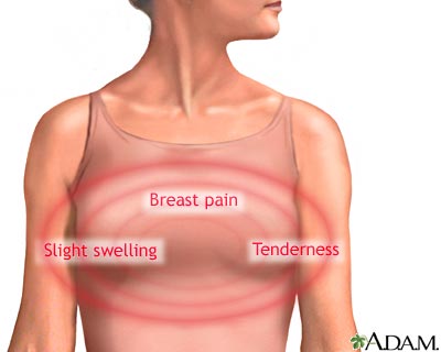 Breast pain Breast pain