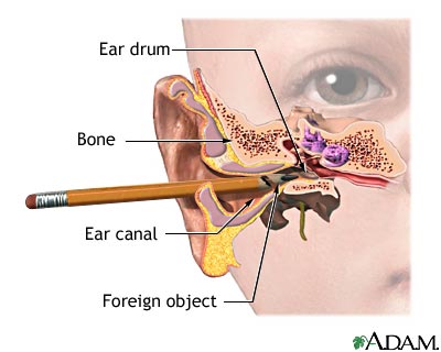 Foreign object in ear Foreign object in ear