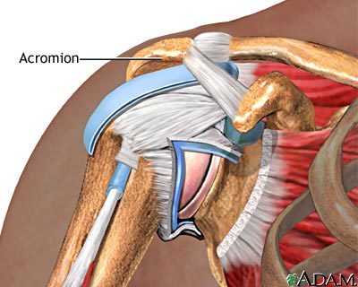 Impingement syndrome Impingement syndrome