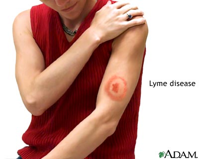 Lyme disease Lyme disease