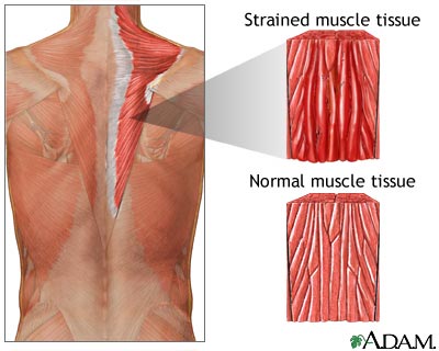 Muscle strain Muscle strain