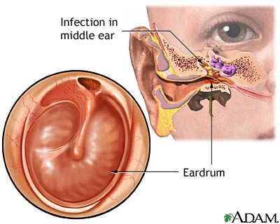 Middle ear infection Middle ear infection