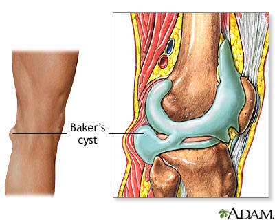 Baker's cyst Baker's cyst