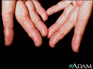 Amyloidosis on the fingers Amyloidosis on the fingers