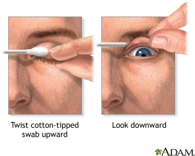 Eyelid eversion Eyelid eversion