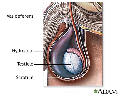 Hydrocele Hydrocele