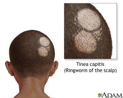 Ringworm of the scalp Ringworm of the scalp