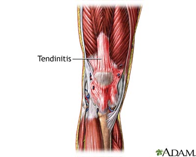 Tendinitis Tendinitis