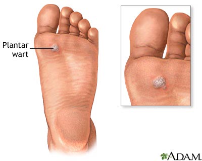 Plantar wart Plantar wart