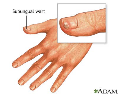 Subungual wart Subungual wart
