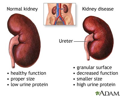 Diabetic nephropathy Diabetic nephropathy