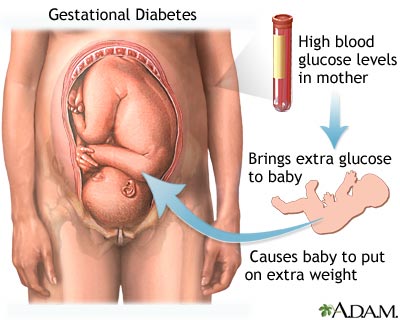 Gestational Diabetes Gestational Diabetes