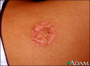 Necrobiosis lipoidica diabeticorum - abdomen Necrobiosis lipoidica diabeticorum - abdomen