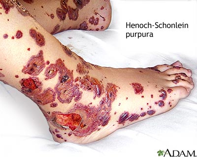 Henoch-Schonlein purpura Henoch-Schonlein purpura