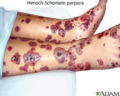 Henoch-Schonlein purpura Henoch-Schonlein purpura