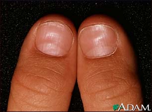 Koilonychia Koilonychia