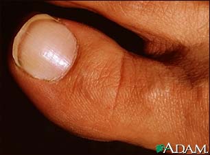 White nail syndrome White nail syndrome