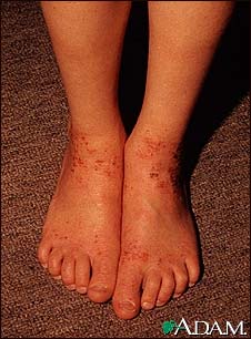 Atopy on the ankles Atopy on the ankles