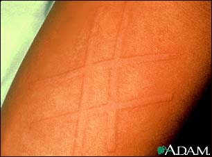 Dermatographism on the arm Dermatographism on the arm