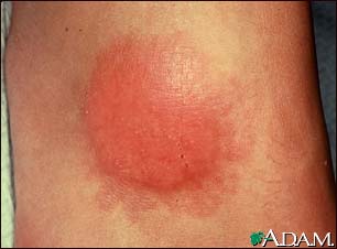 Granuloma annulare - close-up Granuloma annulare - close-up