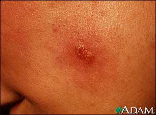 Leishmaniasis, mexicana - lesion on the cheek Leishmaniasis, mexicana - lesion on the cheek