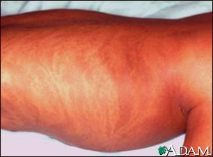 Incontinentia pigmenti - side Incontinentia pigmenti - side