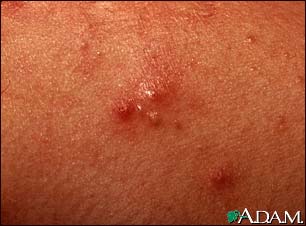 Acne - close-up of pustular lesions Acne - close-up of pustular lesions