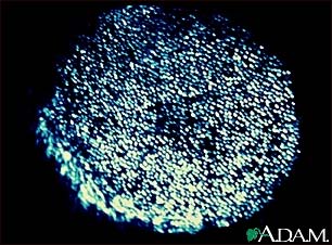 Wood's lamp test - of the scalp Wood's lamp test - of the scalp