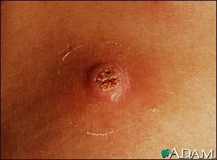 Wart (close-up) Wart (close-up)