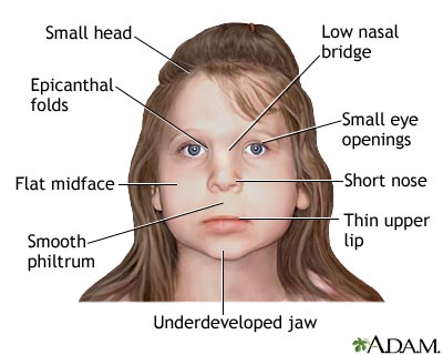 Fetal alcohol syndrome Fetal alcohol syndrome