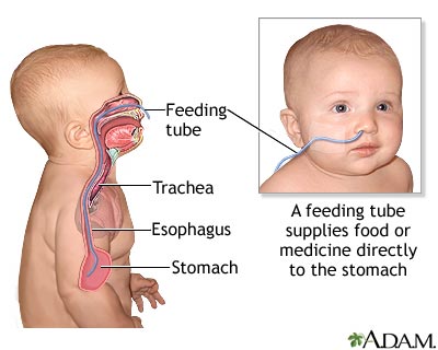 Feeding tube Feeding tube