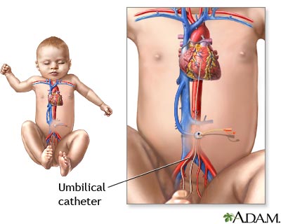 Umbilical catheter Umbilical catheter