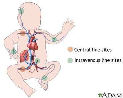 Intravenous fluid sites Intravenous fluid sites