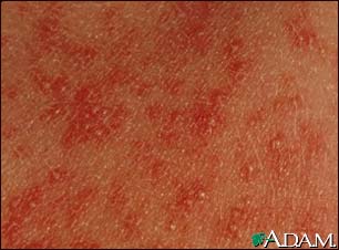 Erythema toxicum neonatorum - close-up Erythema toxicum neonatorum - close-up