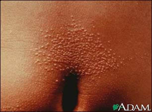 Lichen nitidus on the abdomen Lichen nitidus on the abdomen