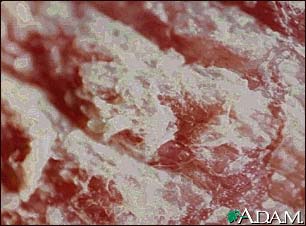 Psoriasis, magnified x4 Psoriasis, magnified x4