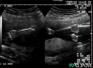 Ultrasound, normal fetus - arms and legs Ultrasound, normal fetus - arms and legs