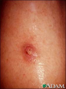 Keratoacanthoma Keratoacanthoma