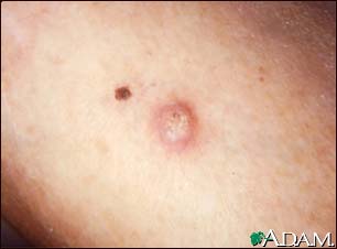 Keratoacanthoma Keratoacanthoma