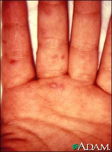Hand, foot, and mouth disease on the hand Hand, foot, and mouth disease on the hand