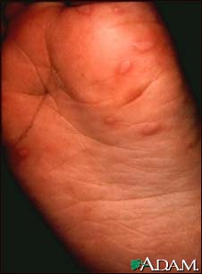 Hand, foot, and mouth disease on the foot Hand, foot, and mouth disease on the foot