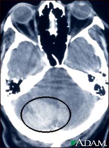 Intracerebellar hemorrhage - CT scan Intracerebellar hemorrhage - CT scan