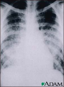Chickenpox, acute pneumonia - chest X-ray Chickenpox, acute pneumonia - chest X-ray