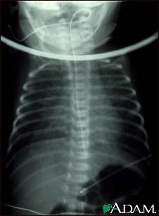 Totally anomalous pulmonary venous return, X-ray Totally anomalous pulmonary venous return, X-ray