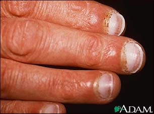 Scurvy, periungual hemorrhage Scurvy, periungual hemorrhage