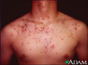 Acne, cystic on the chest Acne, cystic on the chest