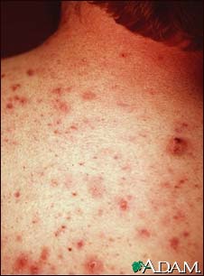 Acne, vulgaris on the back Acne, vulgaris on the back