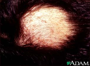 Alopecia areata with pustules Alopecia areata with pustules
