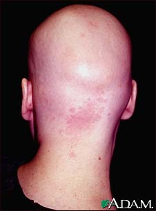 Alopecia totalis - back view of the head Alopecia totalis - back view of the head